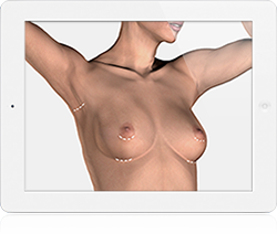 Access Incisions for Breast Enlargement