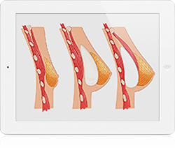 Access Incisions for Breast Enlargement
