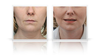  Neck lift,  neck contouring.