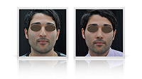 Primary open-tip rhinoplasty, nasal tip correction.