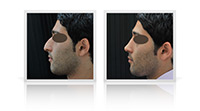 Primary open-tip rhinoplasty, nasal tip correction.
