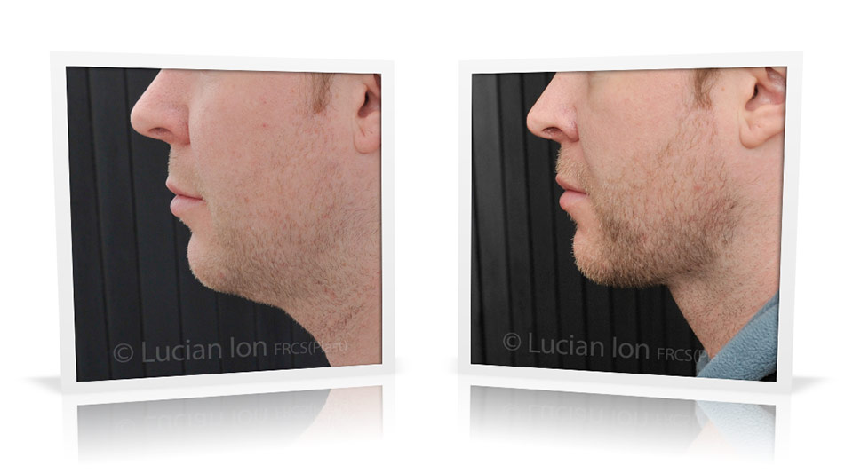 Buccal fat pad / buccal fat pad before and after photos - buccal fat pad  surgery London