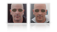 Nasal tip definition, correction of nasal bump.