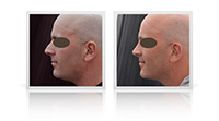 Nasal tip definition, correction of nasal bump.