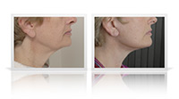 Neck lift, platysma plasty, fat transfer to midface.