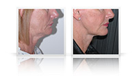 Facelift with neck lift and small fat transfer to midface.