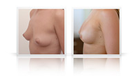 Breast augmentation, cohesive gel implants.