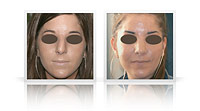 Post traumatic rhinoplasty.