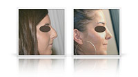 Post traumatic rhinoplasty.