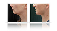 Neck Lift, chin remodeling.