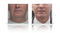 Anterior necklift and chin implant