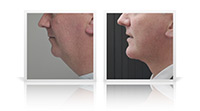 Anterior neck lift, chin implant.