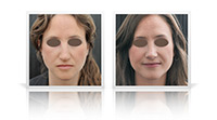 Open tip nose surgery.