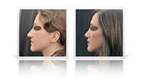 Open tip nose surgery.
