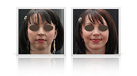Nasal bridge reduction, chin implant, chin augmentation.