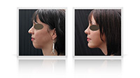 Nasal bridge reduction, chin implant, chin augmentation.