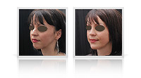 Nasal bridge reduction, chin implant, chin augmentation.