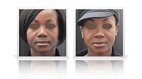 Ethnic rhinoplasty using rib cartilage graft.