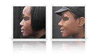 Ethnic rhinoplasty using rib cartilage graft.