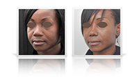 Ethnic rhinoplasty using rib cartilage graft.