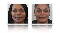 Ethnic rhinoplasty.