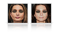 Open tip rhinoplasty for reduction of nasal tip