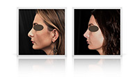 Open tip rhinoplasty for reduction of nasal tip