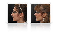 Reduction rhinoplasty for decreased nasal tip and bridge width.