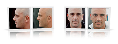 before and after rhinoplasty