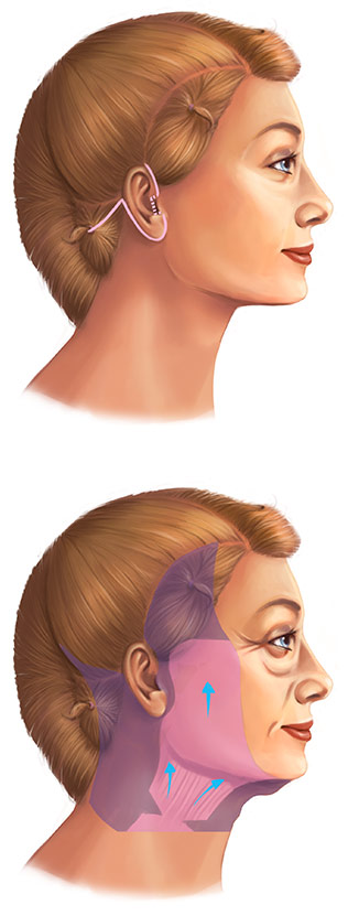 Facelift short scar illustrations