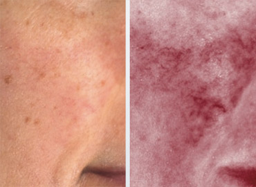 Neck Rejuvenation