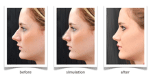 Dimensional Rhinoplasty - A different approach to nose surgery